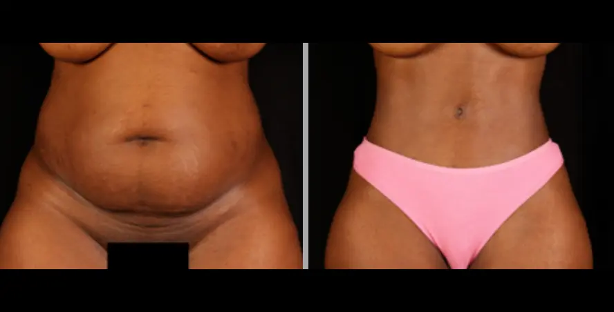 Screen Shot 2022-05-24 at 1.48.00 PM Tummy Tuck