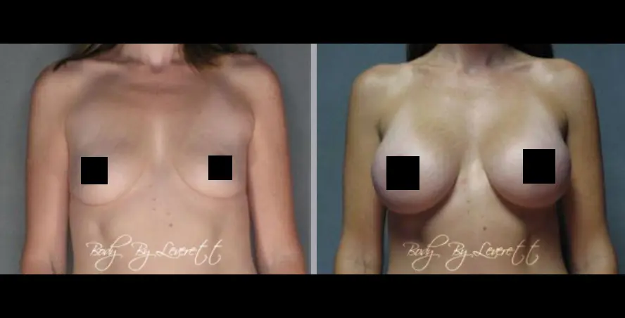 Screen Shot 2022-05-24 at 1.46.07 PM Breast Augmentation