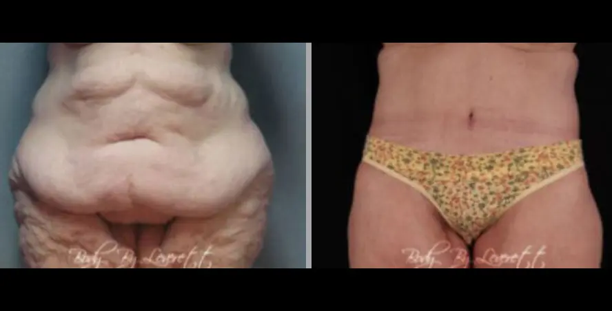 Screen Shot 2022-05-24 at 1.47.10 PM Body Lift