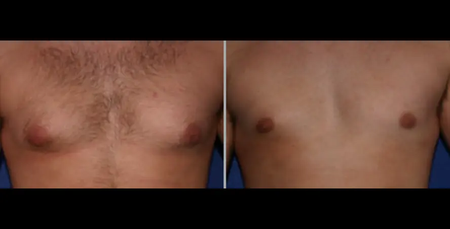gyneco Gynecomastia