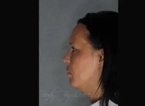 Body by Leverett Before and After Images