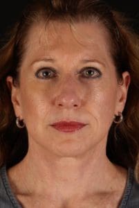 Facelift Before and After Pictures Phoenix, AZ