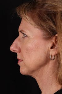 Body by Leverett Before and After Images