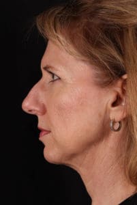 Facelift Before and After Pictures Phoenix, AZ