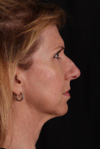 Facelift Before and After Pictures Phoenix, AZ