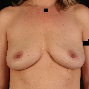 Breast Implant Removal Before and After Pictures in Phoenix, AZ