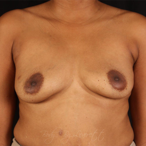 Breast Implant Removal Before and After Pictures in Phoenix, AZ
