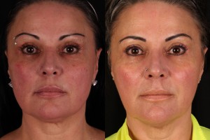 Rosacea Before and After Pictures Phoenix, AZ