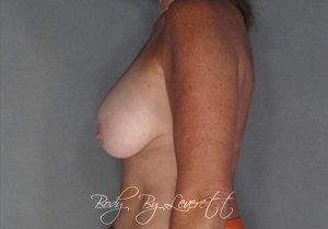 Breast Revision Before and After Pictures Phoenix, AZ