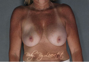 Breast Revision Before and After Pictures Phoenix, AZ