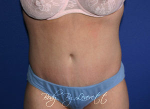 Tummy Tuck Before and After Pictures Phoenix, AZ
