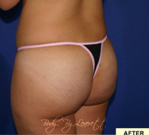 Brazilian Butt Lift Before and After Pictures Phoenix, AZ