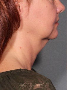 Neck Lift Before and After Pictures Phoenix, AZ