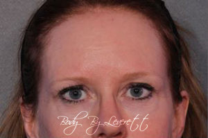 Blepharoplasty Before and After Pictures Phoenix, AZ