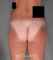 Brazilian Butt Lift Before and After Pictures Phoenix, AZ