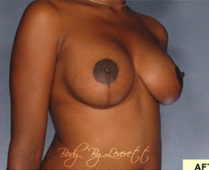 Breast Lift Before and After Pictures Phoenix, AZ
