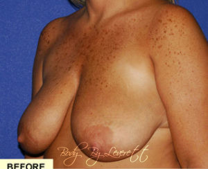 Breast Lift Before and After Pictures Phoenix, AZ