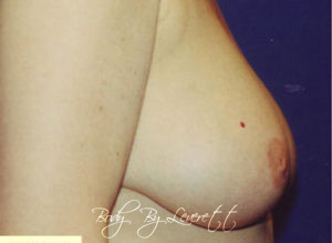 Breast Reduction Before and After Pictures Phoenix, AZ