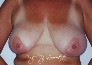 Breast Reduction Before and After Pictures Phoenix, AZ