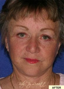 Body by Leverett Before and After Images