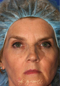 Brow Lift Before and After Pictures Phoenix, AZ