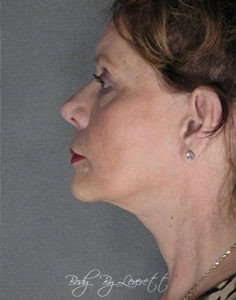 Neck Lift Before and After Pictures Phoenix, AZ