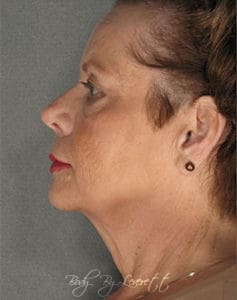 Body by Leverett Before and After Images
