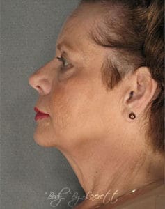 Neck Lift Before and After Pictures Phoenix, AZ