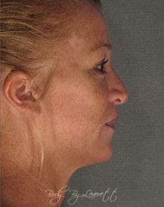 Body by Leverett Before and After Images