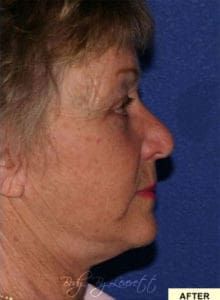 Neck Lift Before and After Pictures Phoenix, AZ