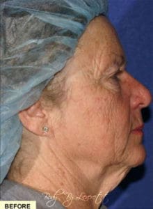 Neck Lift Before and After Pictures Phoenix, AZ