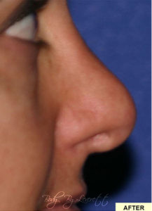 Rhinoplasty Before and After Pictures Phoenix, AZ