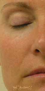 HydraFacial Before and After Pictures Phoenix, AZ