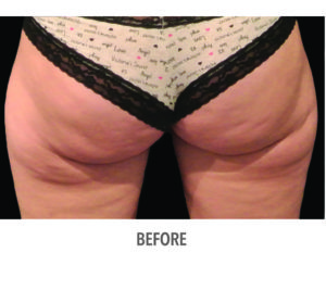 CoolSculpting® Before and After Pictures Phoenix, AZ