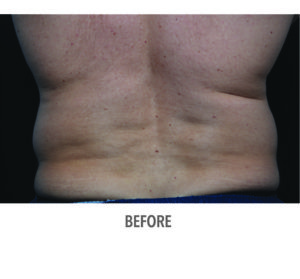 CoolSculpting® Before and After Pictures Phoenix, AZ