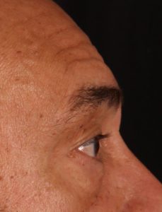 Blepharoplasty Before and After Pictures Phoenix, AZ