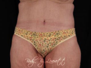 Body Lift or Belt Lipectomy Before & After Pictures in Phoenix, AZ