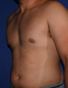 Gynecomastia Before and After Pictures Phoenix, AZ