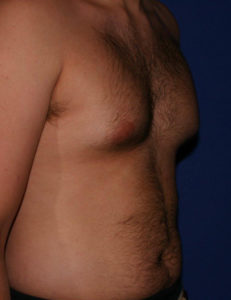 Gynecomastia Before and After Pictures Phoenix, AZ