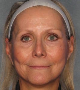 Facelift Before and After Pictures Phoenix, AZ