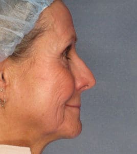 Facelift Before and After Pictures Phoenix, AZ