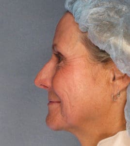 Facelift Before and After Pictures Phoenix, AZ