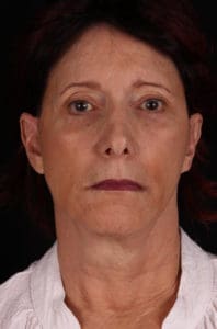 Facelift Before and After Pictures Phoenix, AZ