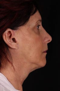 Facelift Before and After Pictures Phoenix, AZ