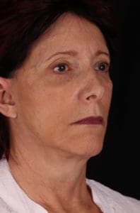 Facelift Before and After Pictures Phoenix, AZ