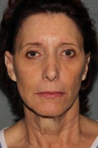 Facelift Before and After Pictures Phoenix, AZ