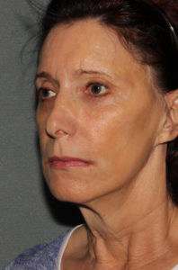 Facelift Before and After Pictures Phoenix, AZ