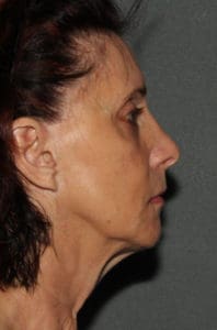 Facelift Before and After Pictures Phoenix, AZ