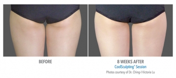 CoolSculpting® Before and After Pictures Phoenix, AZ