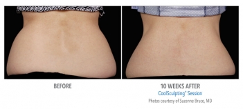 CoolSculpting® Before and After Pictures Phoenix, AZ